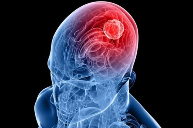 أسعار الأشعة التداخلية على المخ