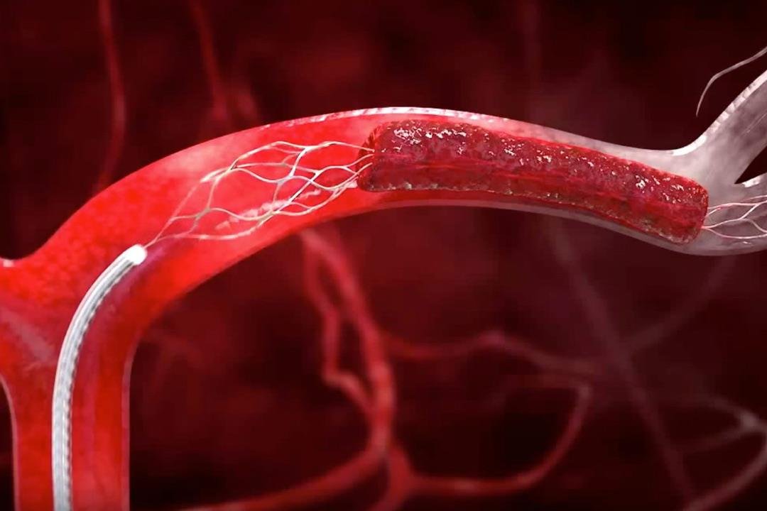 علاج مشاكل الاوعية الدموية