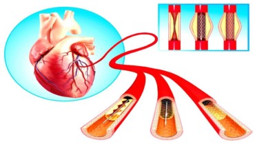 أسعار القسطرة القلبية العلاجية
