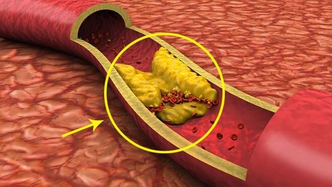 أحدث تقنيات علاج انسداد الشرايين الدماغية في مصر – تطور ينقذ آلاف المرضى