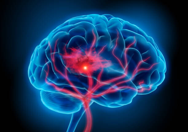 كيف يتم علاج تمدد الأوعية الدموية في الدماغ