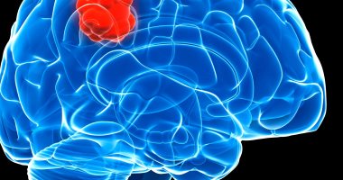 علاج أورام الدماغ واسبابها وطرق تشخيصها