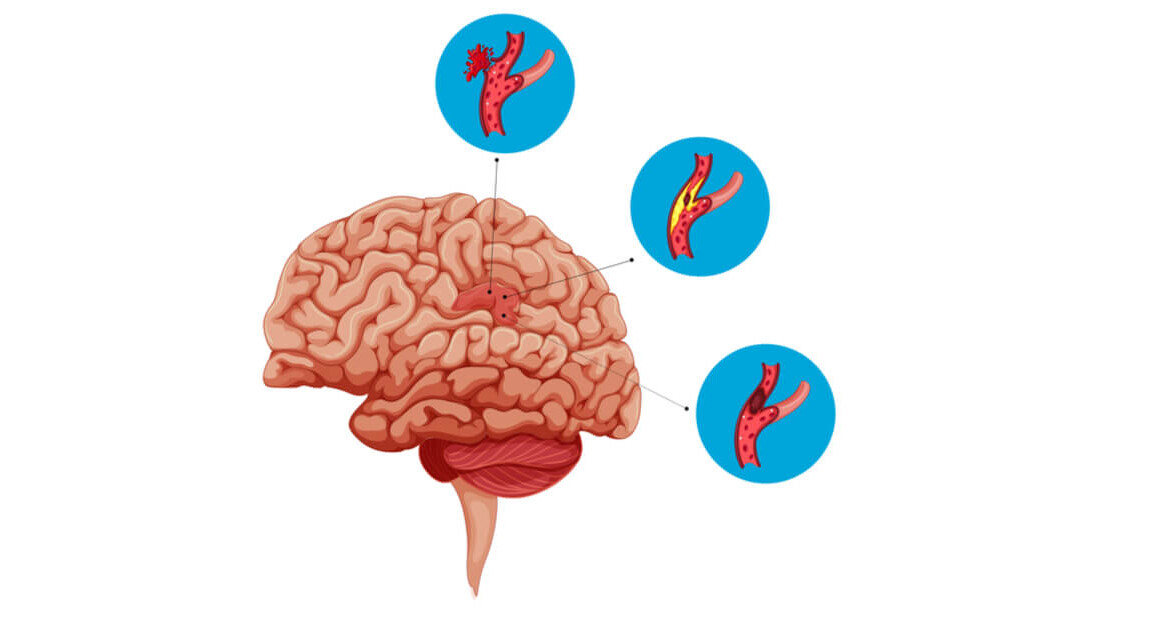 علاج تمدد الأوعية الدموية في الدماغ