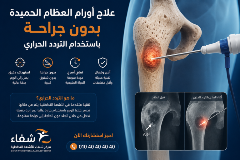 علاج أورام العظام الحميدة بدون جراحة باستخدام التردد الحراري